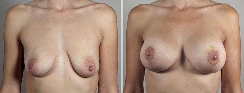 Breast Lift with Implants Patient 48