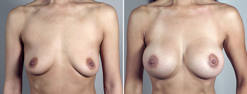Breast Lift with Implants Patient 49