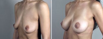 Breast Lift with Implants Patient 49