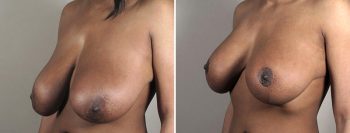 Removal & Replacement of Implants Patient 36