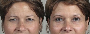 Browlift & Upper Eyelid Lift Patient 23