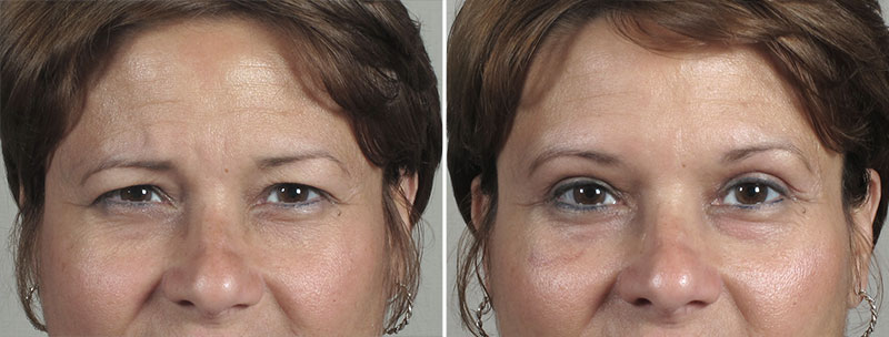 Browlift & Upper Eyelid Lift Patient 23