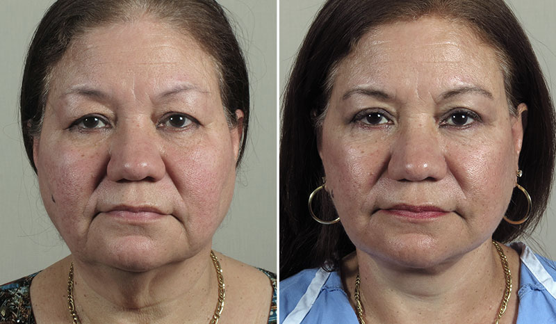 Facelift, Neck lift & Eyelid Lift Patient 33