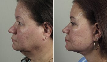 Facelift, Neck lift & Eyelid Lift Patient 33