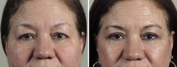 Facelift, Neck lift & Eyelid Lift Patient 33