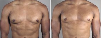 Gynecomastia Reduction Patient 57