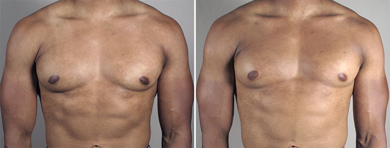 Gynecomastia Reduction Patient 57