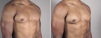 Gynecomastia Reduction Patient 57