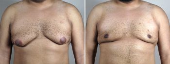 Gynecomastia Reduction Patient 58