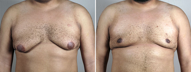 Gynecomastia Reduction Patient 58