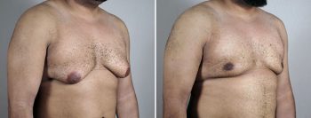Gynecomastia Reduction Patient 58