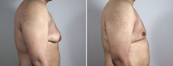 Gynecomastia Reduction Patient 58