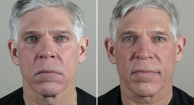 Parker Rejuvenation Lift Patient 11