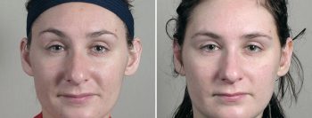 Otoplasty Patient 11