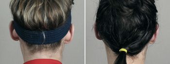 Otoplasty Patient 11