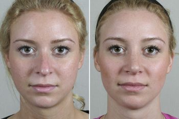 Rhinoplasty Patient 69