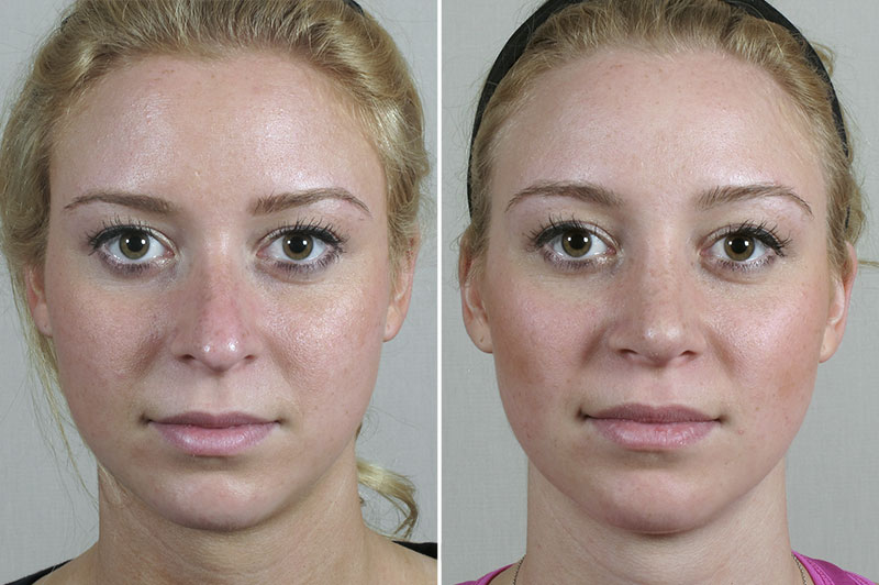 Rhinoplasty Patient 69