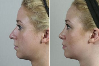 Rhinoplasty Patient 69