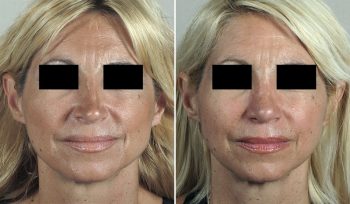 Rhinoplasty Patient 68