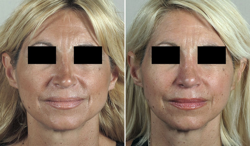 Rhinoplasty Patient 68