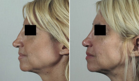 Before & After: Secondary Rhinoplasty Rhinoplasty New Jersey Image
