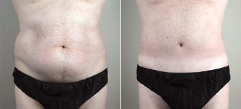 Male lipoabdominoplasty Patient 13