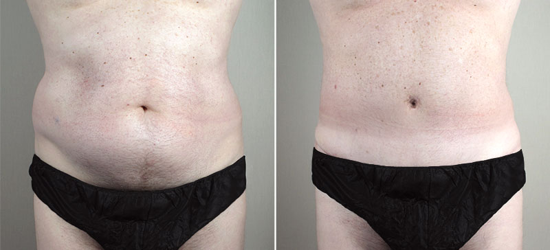 Male lipoabdominoplasty Patient 13