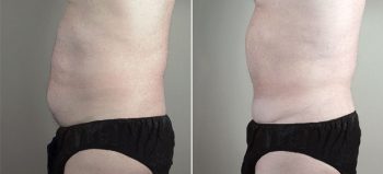 Male lipoabdominoplasty Patient 13