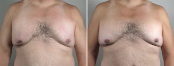 Inverted Nipple Correction Patient 13 – male