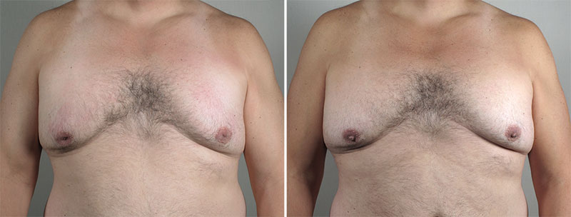 Inverted Nipple Correction Patient 13 – male