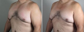 Inverted Nipple Correction Patient 13 – male