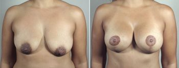 Mommy Makeover Patient 30