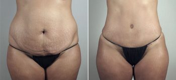 Mommy Makeover Patient 30