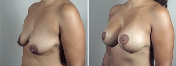 Mommy Makeover Patient 30