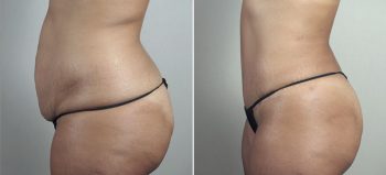 Mommy Makeover Patient 30