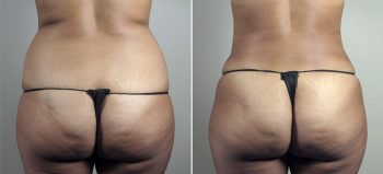 Mommy Makeover Patient 30