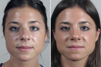 Rhinoplasty Patient 70