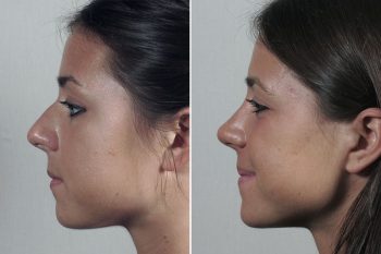 Rhinoplasty Patient 70