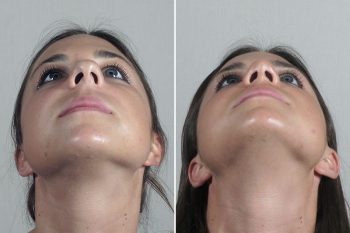 Rhinoplasty Patient 70