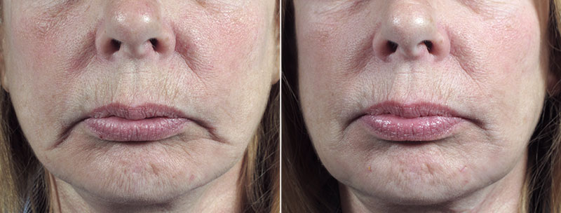 Facial Fillers Patient 8 – Fat Transfer