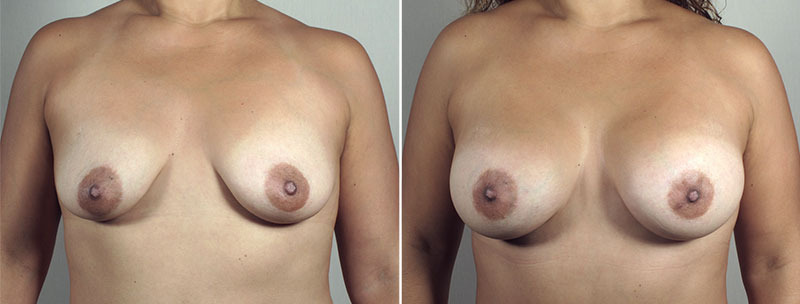 Mommy Makeover Patient 31