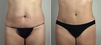 Mommy Makeover Patient 31