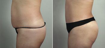 Mommy Makeover Patient 31