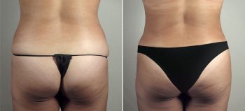 Mommy Makeover Patient 31