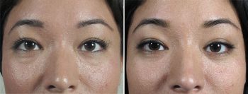 Lower Eyelid Lift Patient 41