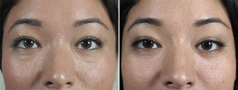Lower Eyelid Lift Patient 41