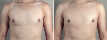 Gynecomastia Reduction Patient 59