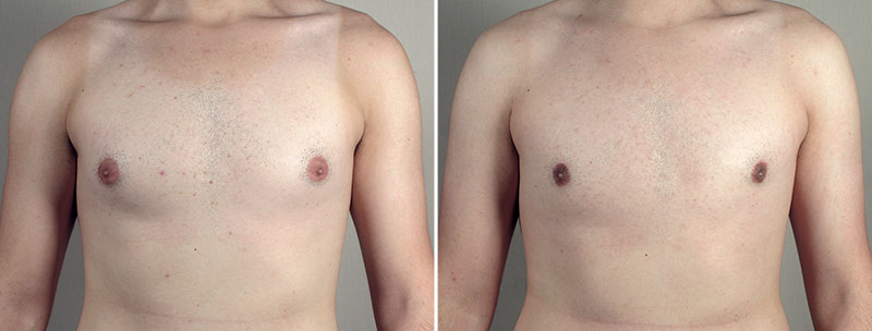Gynecomastia Reduction Patient 59