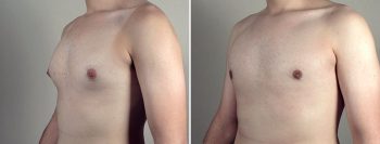 Gynecomastia Reduction Patient 59