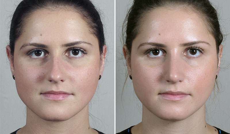 Rhinoplasty Patient 71